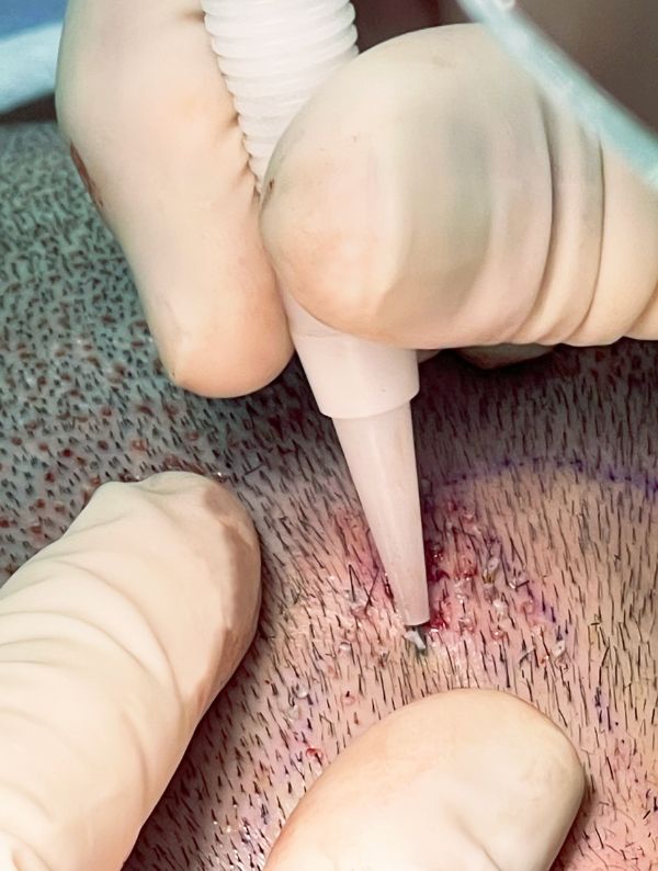 mesoterapia-capilar-con-vitaminas-barcelona