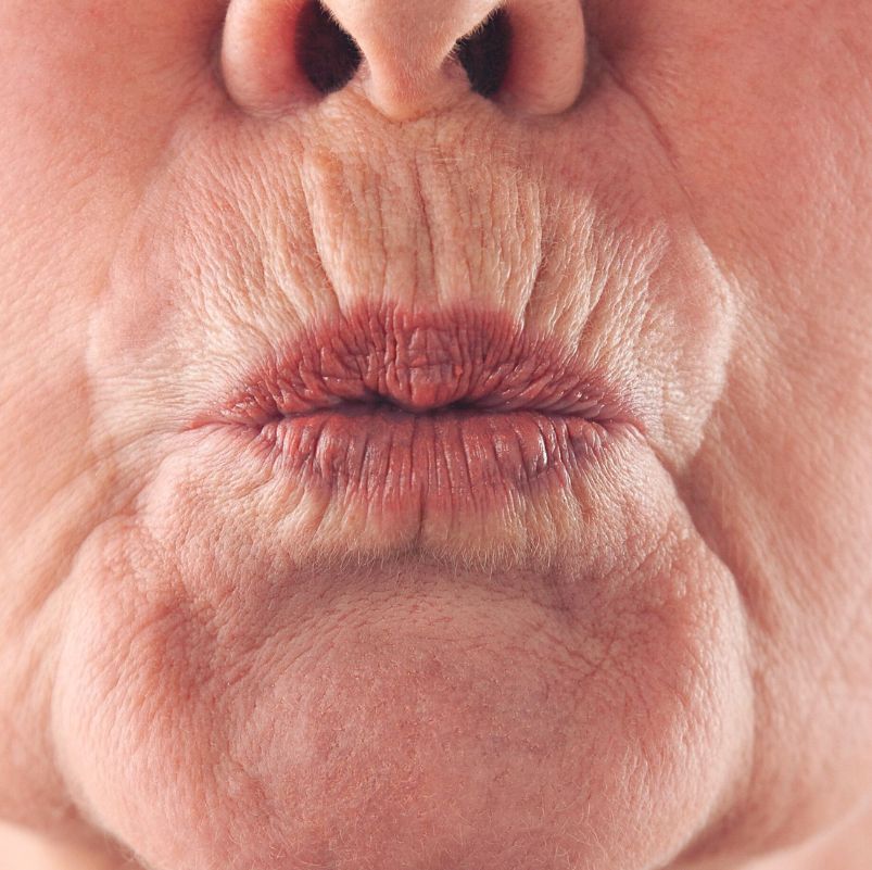 arrugas-periobucales-verticales-codigo-de-barras-barcelona