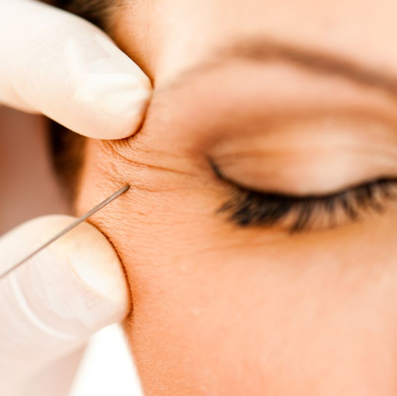 que-es-neuromodulacion-botox-barcelona