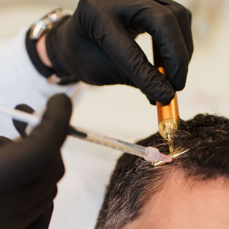 mesoterapia-capilar-barcelona-Garcia-Quiroga
