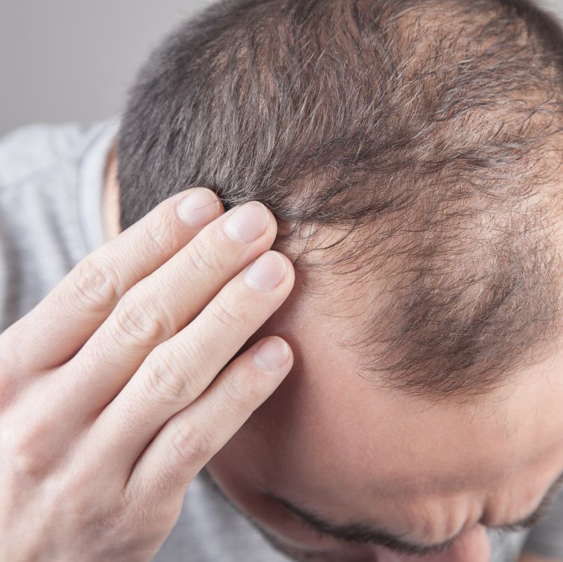 que-es-la-alopecia-medicina-capilar-barcelona