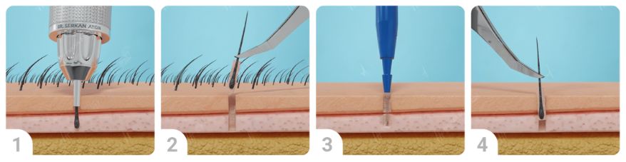 transplante-capilar-tecnica-fue-zafiro