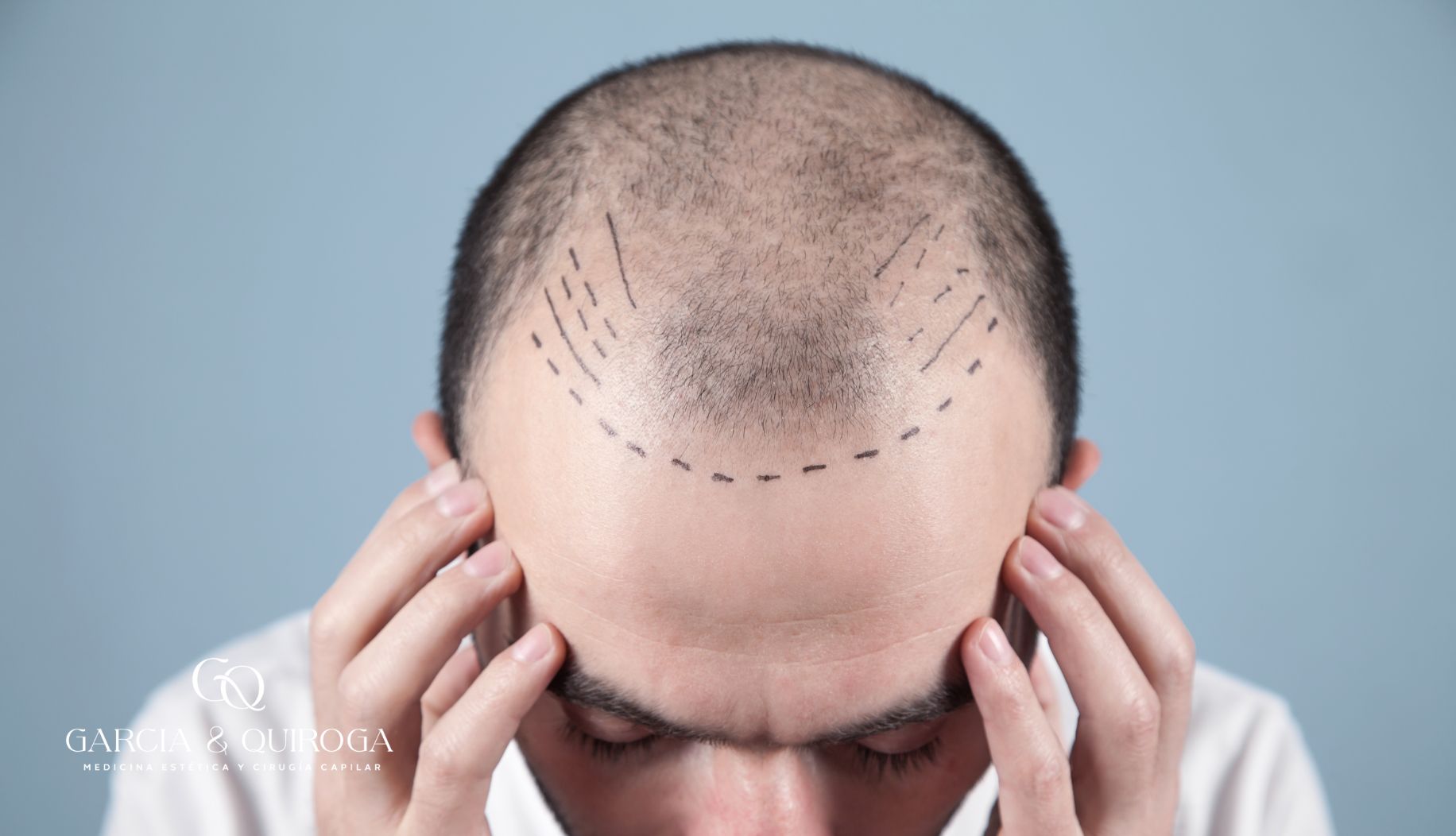 cirugia-capilar-barcelona-todo-lo-que-debes-saber