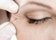 neuromodulacion-lineas-expresion-botox-barcelona