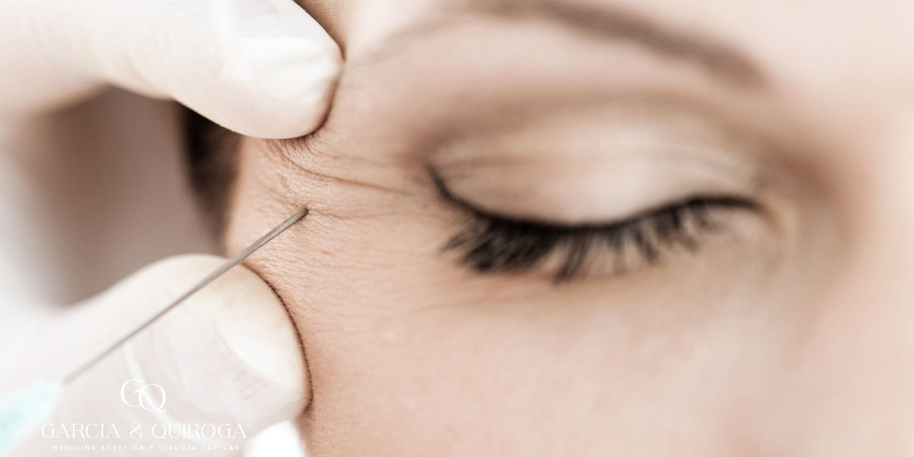 neuromodulacion-lineas-expresion-botox-barcelona neuromodulacion-lineas-expresion-botox-barcelona