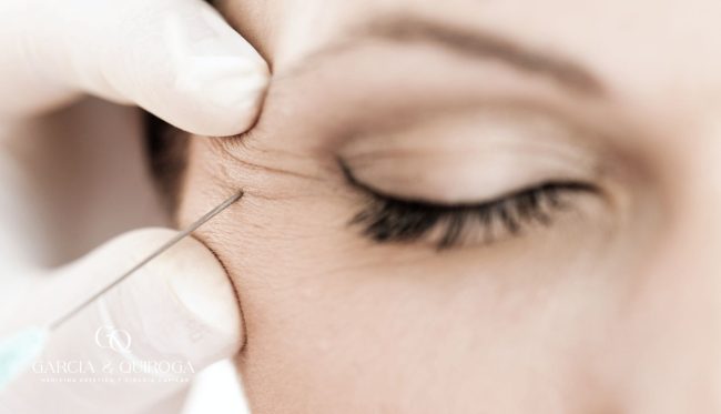 neuromodulacion-lineas-expresion-botox-barcelona neuromodulacion-lineas-expresion-botox-barcelona